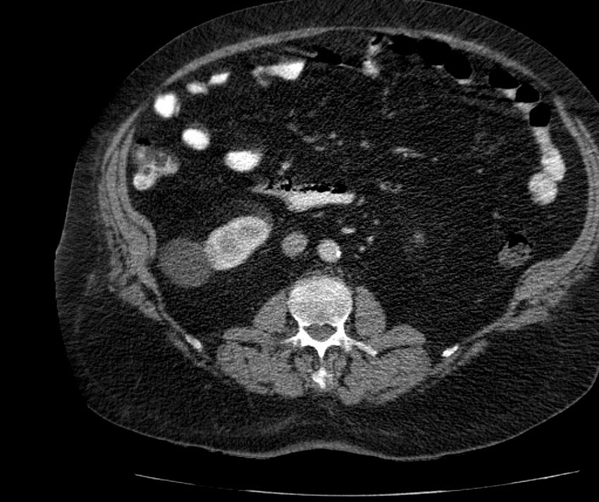 Nephroptosis with inguinal hernia containing perirenal fat (Radiopaedia 56632-63391 C 168).jpg