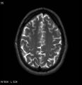 Neurosarcoidosis (Radiopaedia 10930-17204 Axial T2 16).jpg