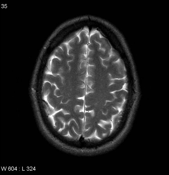 File:Neurosarcoidosis (Radiopaedia 10930-17204 Axial T2 16).jpg