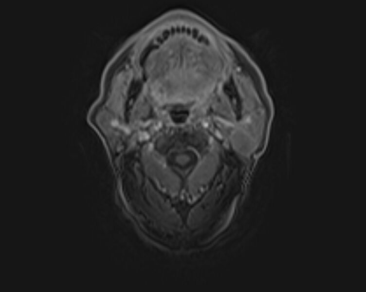 File:Non-Hodgkin lymphoma - parotid gland (Radiopaedia 71531-81890 E 36).jpg