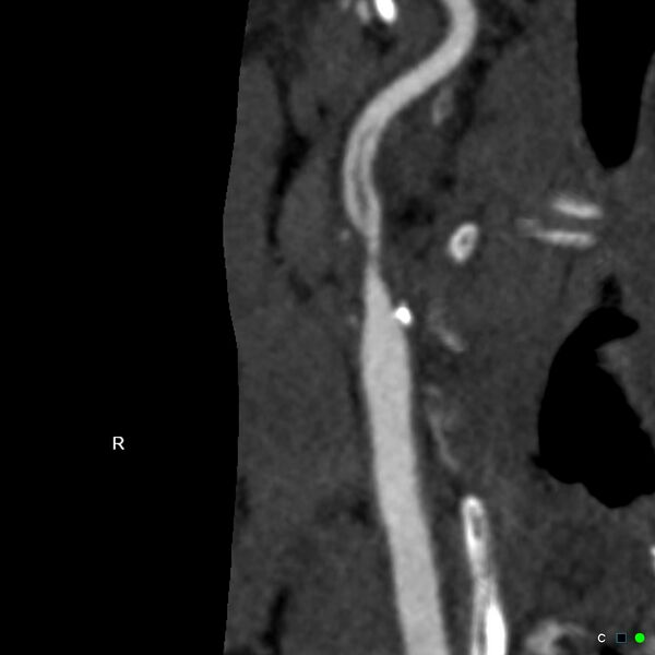 File:Non-occlusive intraluminal internal carotid artery thrombus (Radiopaedia 37751-39658 A 4).jpg