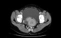 Non-puerperal uterine inversion (Radiopaedia 78343-91094 A 47).jpg