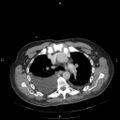 Non Hodgkin lymphoma in a patient with ankylosing spondylitis (Radiopaedia 84323-99624 B 11).jpg
