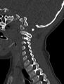 Normal CT cervical spine - pediatric (Radiopaedia 52549-58462 Sagittal bone window 59).jpg