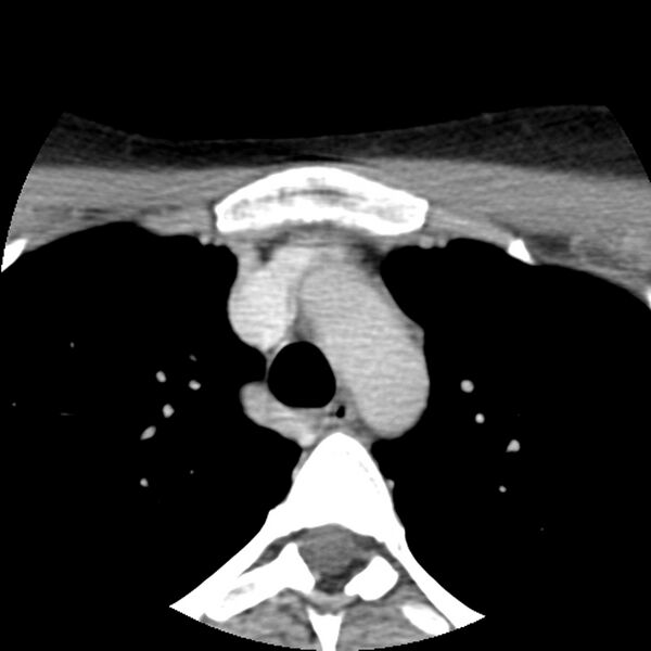 File:Normal CT of the neck (Radiopaedia 14575-14500 Axial C+ 77).jpg