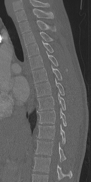 File:Normal CT thoracic spine (Radiopaedia 40181-42688 Sagittal bone window 37).png