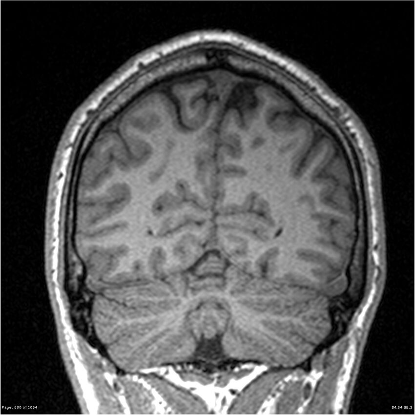 Normal brain MRI (non-focal epilepsy protocol) (Radiopaedia 38571-40700 Coronal T1 26).jpg