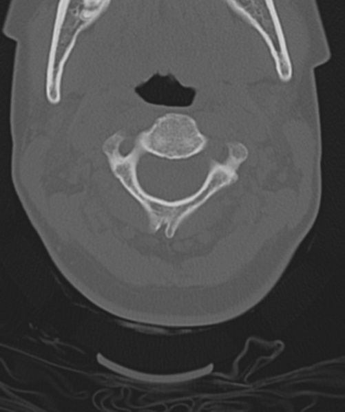 File:Normal cervical spine MRI (including Dixon) (Radiopaedia 42762-45926 Axial bone window 18).png