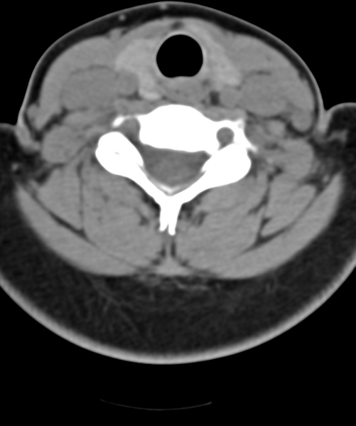 File:Normal cervical spine MRI (including Dixon) (Radiopaedia 42762-45926 Axial non-contrast 40).png