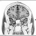 Normal coronal brain (Radiopaedia 6676-7910 B 10).jpg