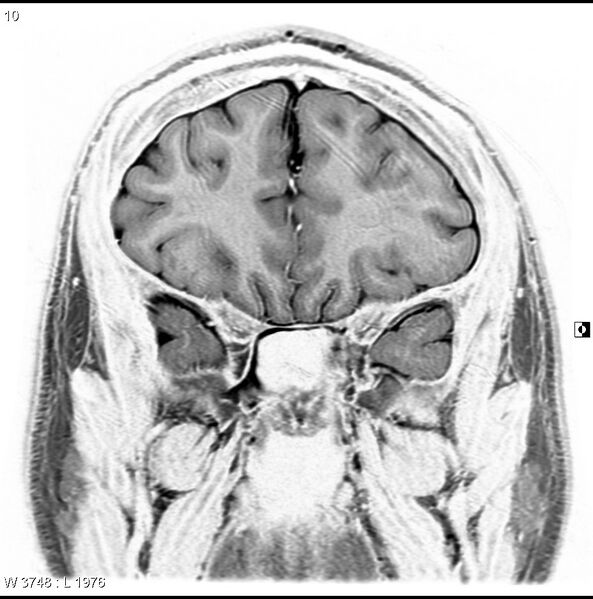 File:Normal coronal brain (Radiopaedia 6676-7910 B 10).jpg