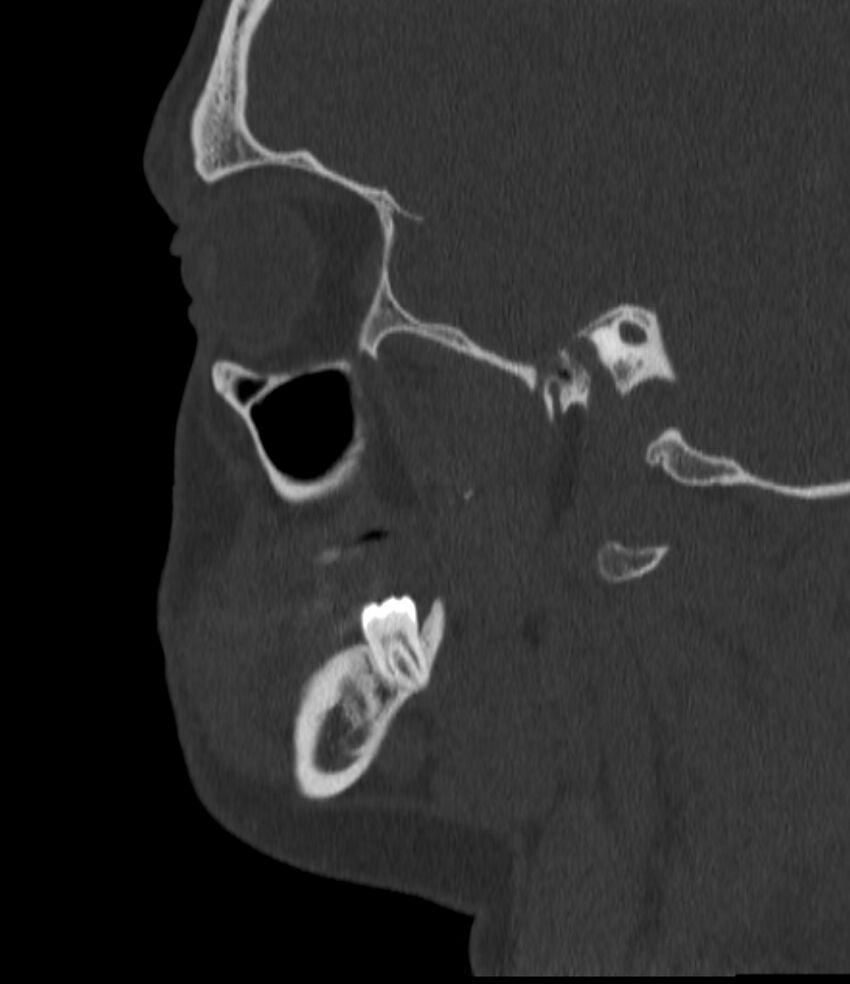 Normal facial bone CT (Radiopaedia 88742-105476 Sagittal bone window 55).jpg