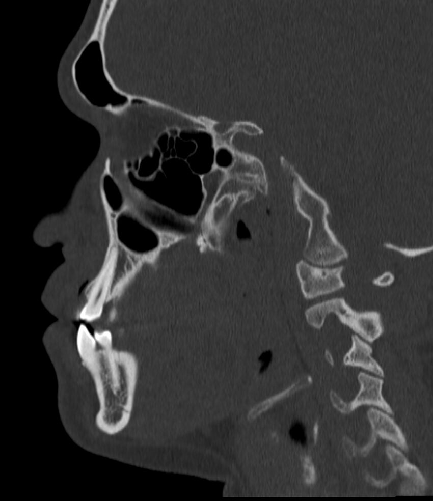 Normal facial bone CT (Radiopaedia 88742-105476 Sagittal bone window 73).jpg