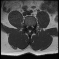 Normal lumbar spine MRI (Radiopaedia 35543-37039 Axial T1 18).png