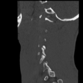 Normal trauma cervical spine (Radiopaedia 41017-43760 Sagittal bone window 40).png