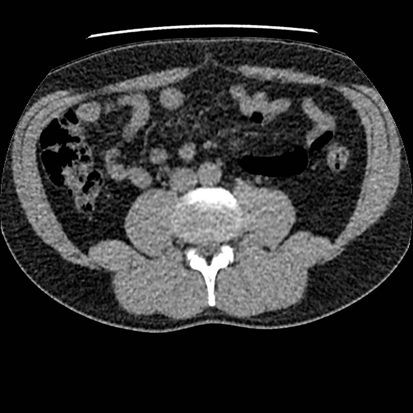 Obstructing ureteric calculus and ureteric anatomy (Radiopaedia 62730-71042 Axial non-contrast 75).jpg