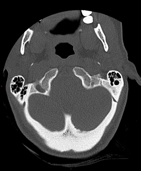 File:Occipital condyle fracture (Radiopaedia 61165-69056 D 6).jpg