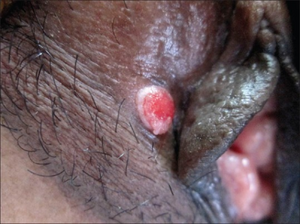 Papillary hidradenoma (vulva).png
