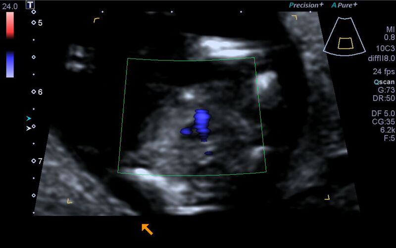 File:1st trimester nuchal-morphology ultrasound (Radiopaedia 44706-48477 Heart views cine with colour 149).jpg