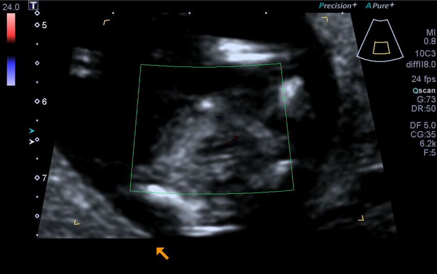 1st trimester nuchal-morphology ultrasound (Radiopaedia 44706-48477 Heart views cine with colour 155).jpg