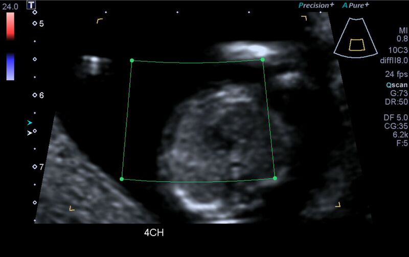 File:1st trimester nuchal-morphology ultrasound (Radiopaedia 44706-48477 Heart views cine with colour 6).jpg