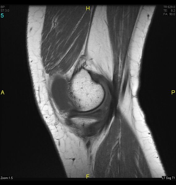 File:ACL mucoid degeration with cystic changes (Radiopaedia 48428-53341 Sagittal T1 3).jpg