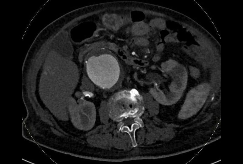 File:Abdominal aortic aneurysm with thrombus fissuration (Radiopaedia 73192-83919 Axial C+ arterial phase 69).jpg