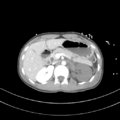 Abdominal multi-trauma - devascularised kidney and liver, spleen and pancreatic lacerations (Radiopaedia 34984-36486 Axial C+ portal venous phase 26).png