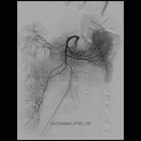 File:Abernethy malformation (Radiopaedia 42006-45462 Frontal Superior mesenteric artery 8).jpg