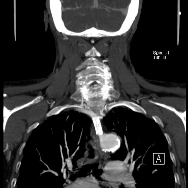 File:Aberrant right subclavian artery (Radiopaedia 22395-22430 Coronal C+ arterial phase 11).jpg