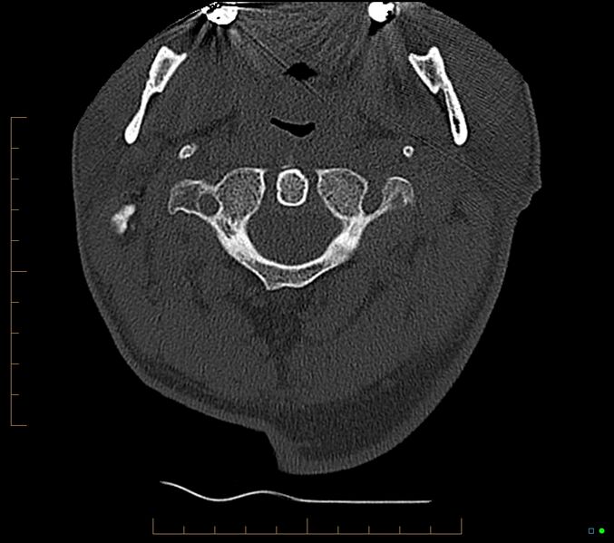 File:Accessory articulation of cervical transverse processes (Radiopaedia 82715-96933 Axial non-contrast 20).jpg