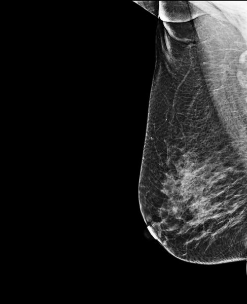 File:Accessory breast tissue (Radiopaedia 74571-85500 B 1).jpg