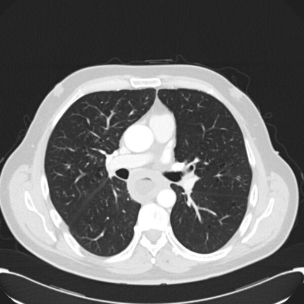 File:Achalasia (Radiopaedia 24937-25206 Axial lung window 16).jpg