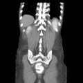 Actinomycosis related to longstanding IUD (Radiopaedia 77303-89380 Coronal C+ portal venous phase 51).jpg