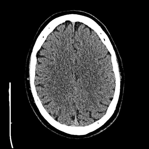 File:Acute A3 occlusion with ACA ischemic penumbra (CT perfusion) (Radiopaedia 72036-82525 Axial non-contrast thins 72).jpg