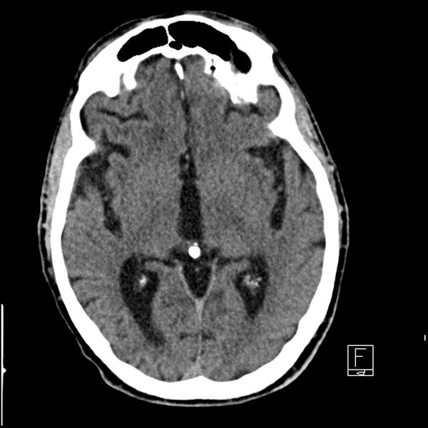 File:Acute ICA ischemic penumbra due to high-grade CCA stenosis (CT perfusion) (Radiopaedia 72038-82529 Axial non-contrast 22).jpg