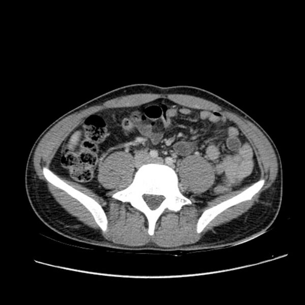 File:Acute appendicitis (Radiopaedia 27049-27227 Axial C+ portal venous phase 46).jpg