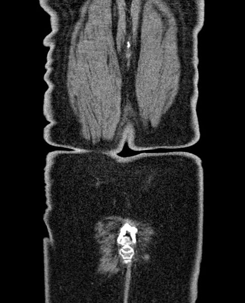 File:Acute appendicitis (Radiopaedia 58627-65818 Coronal non-contrast 62).jpg
