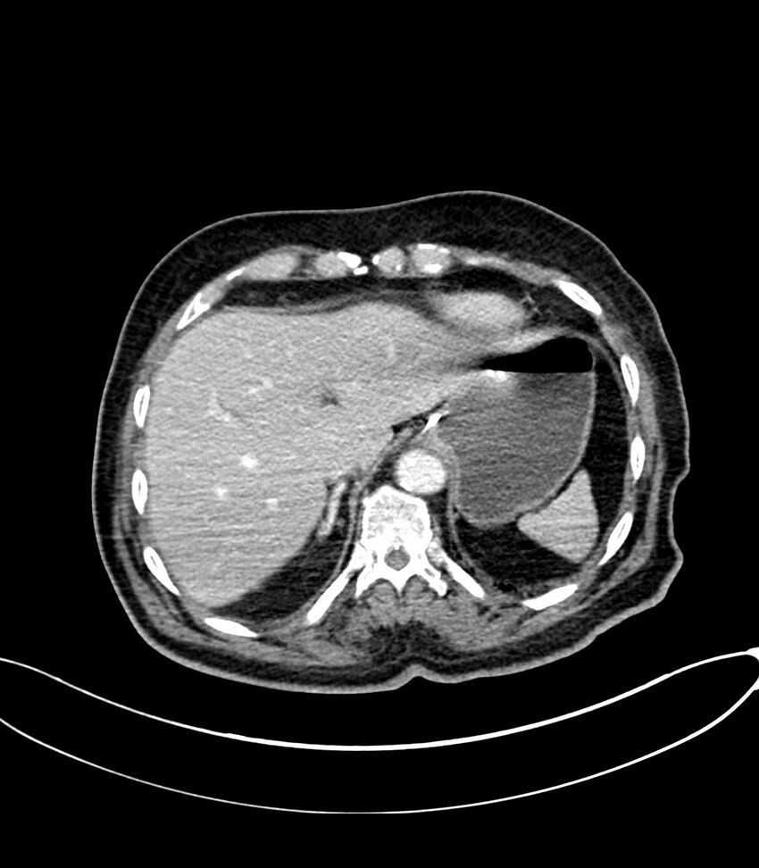Acute arterial mesenteric ischemia (Radiopaedia 78238-90828 Axial C+ portal venous phase 28).jpg