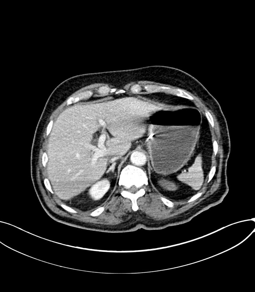 Acute arterial mesenteric ischemia (Radiopaedia 78238-90828 Axial C+ portal venous phase 32).jpg