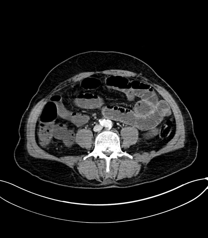 Acute arterial mesenteric ischemia (Radiopaedia 78238-90828 Axial C+ portal venous phase 84).jpg