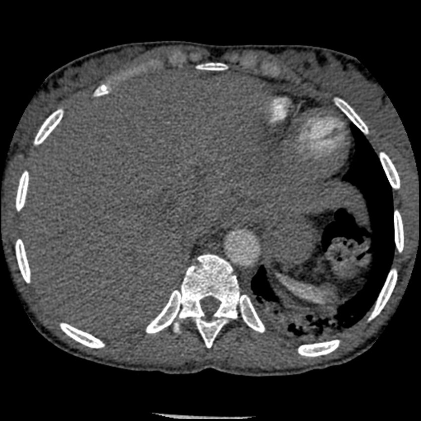 Acute chest syndrome - sickle cell disease (Radiopaedia 42375-45499 Axial C+ CTPA 163).jpg