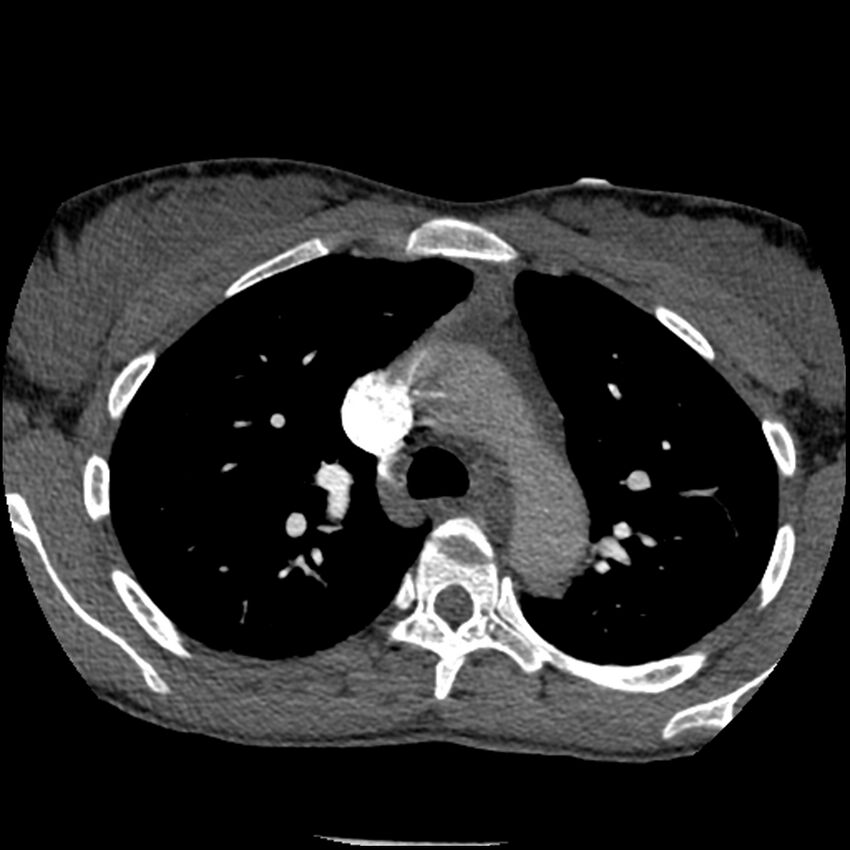 Acute chest syndrome - sickle cell disease (Radiopaedia 42375-45499 Axial C+ CTPA 61).jpg