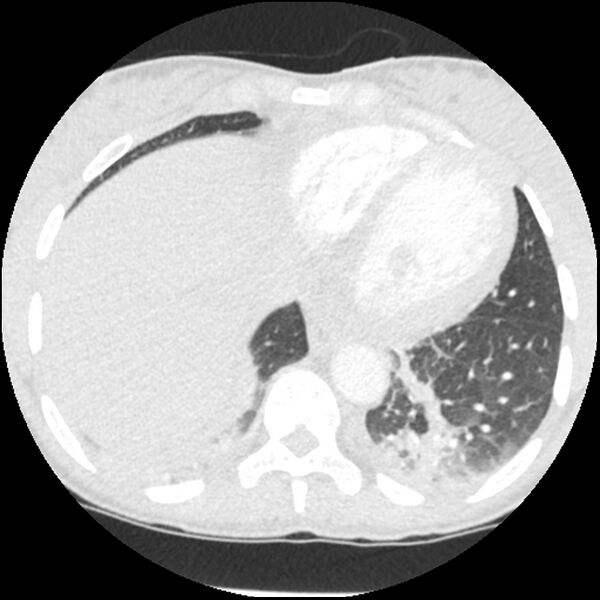 File:Acute chest syndrome - sickle cell disease (Radiopaedia 42375-45499 Axial lung window 151).jpg