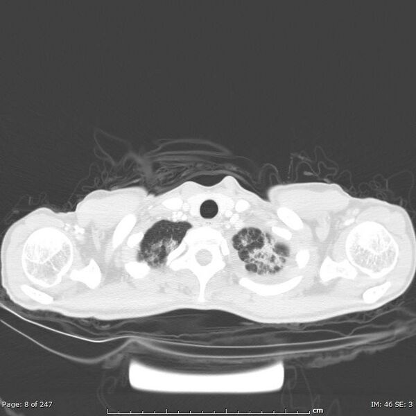File:Acute eosinophilic pneumonia (Radiopaedia 48211-53073 Axial lung window 3).jpg
