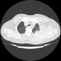 Acute heart failure (CT) (Radiopaedia 79835-93075 Axial lung window 7).png