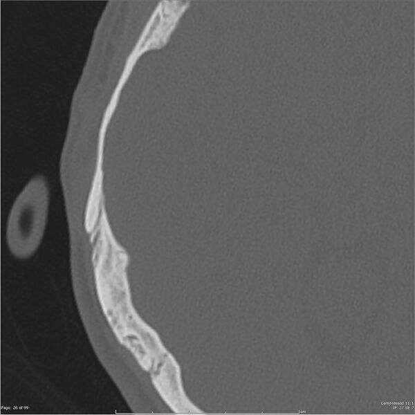File:Acute otomastoiditis (Radiopaedia 28276-28512 Axial PTB bone window reformat 6).jpg