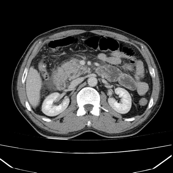 File:Acute pancreatitis (Radiopaedia 22572-22596 Axial C+ portal venous phase 28).jpg