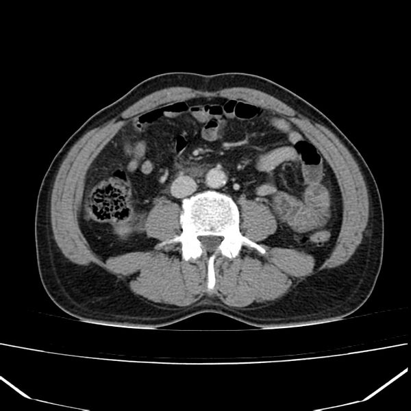 File:Acute pancreatitis (Radiopaedia 22572-22596 Axial C+ portal venous phase 41).jpg