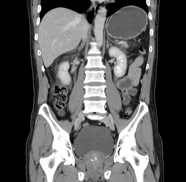 File:Acute pancreatitis (Radiopaedia 22572-22596 Coronal C+ portal venous phase 32).jpg